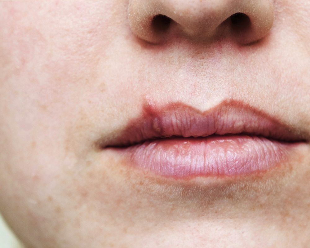 Cold sores on lips